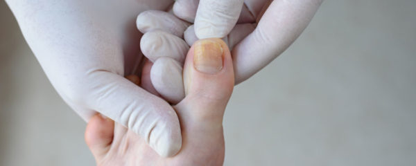 mycose de l'ongle du pied